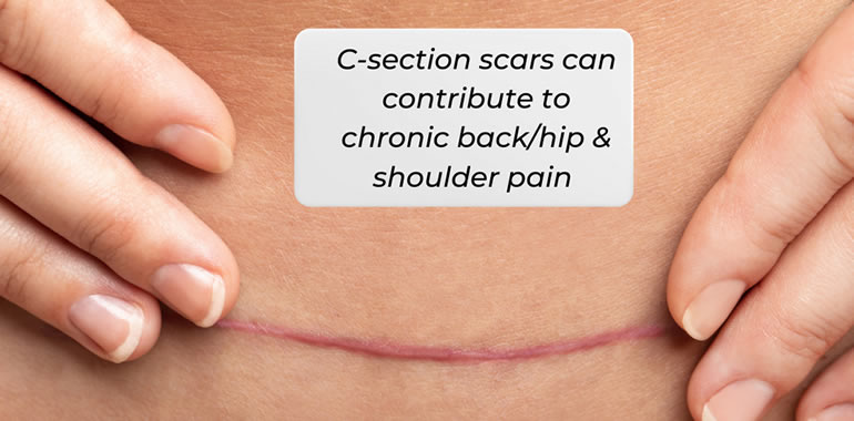 C-section scars contribute to chronic pain