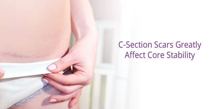 C Section Scar